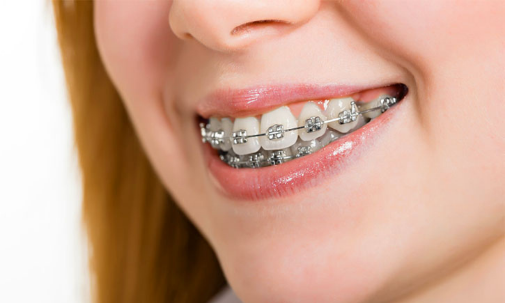 Diş Teli Tedavisi - Ortodonti