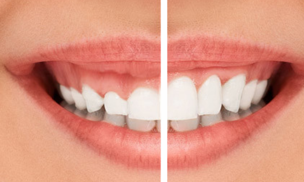 Diş Eti Tedavisi - Periodontoloji